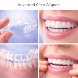 Advanced Clear Aligners