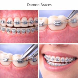 Damon Braces (Clips)