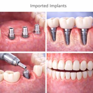 Imported Implants