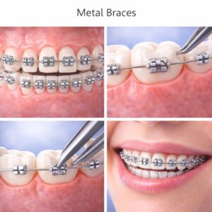 Metal Braces (Clips)